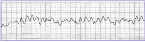 Heartbeat under cardiac arrest